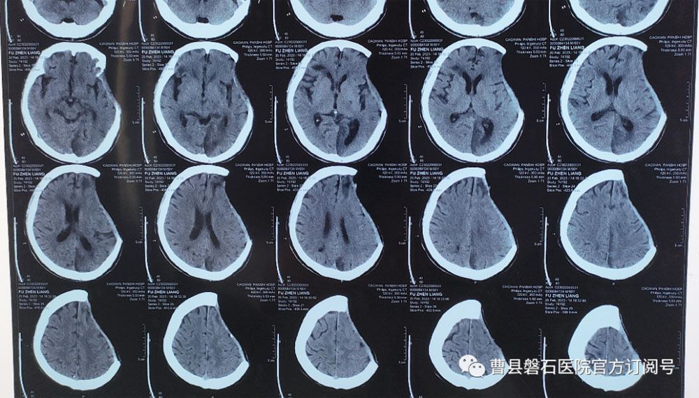 曹县磐石医院成功实施颅骨缺损 PEEK 修补术