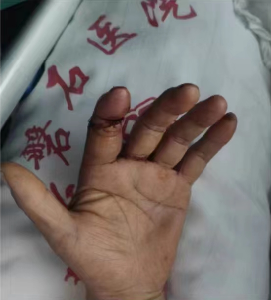 电锯惊魂！患者遭电锯断指，历经4个半小时奋力再植