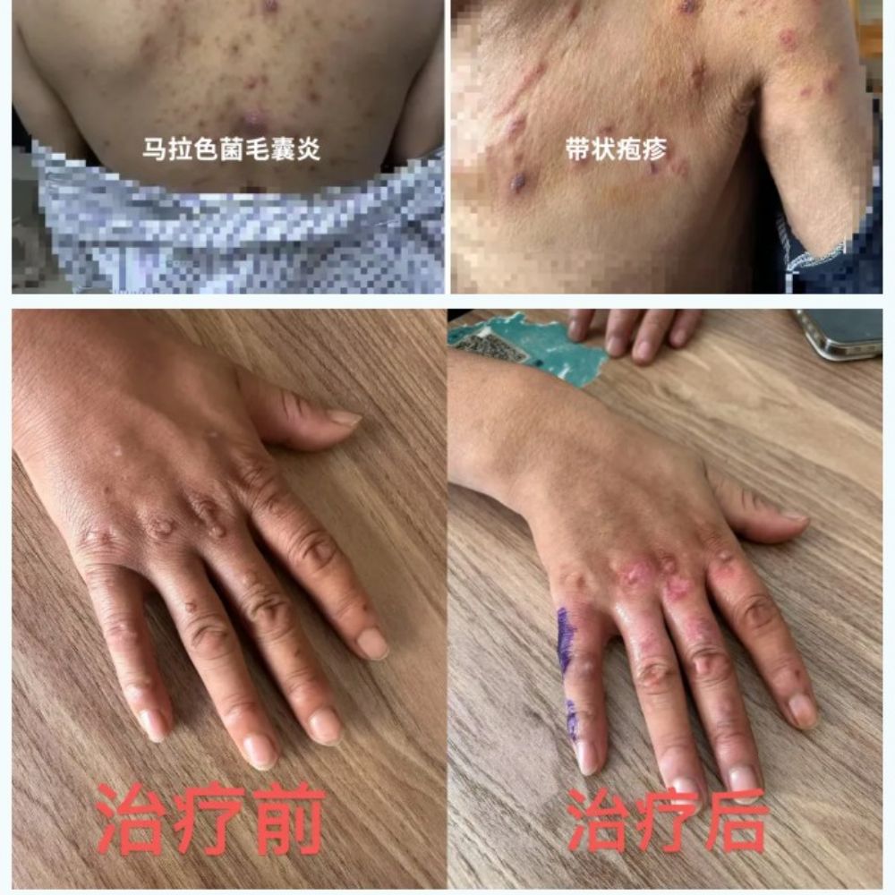 近期丨多位久治不愈皮肤病患者在此康复